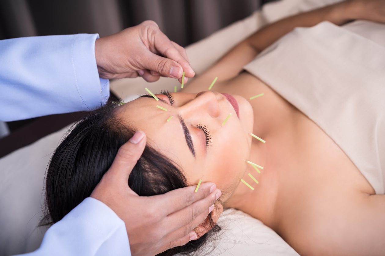 Acupuncture : Guérir naturellement avec des aiguilles – et ce que votre assurance maladie couvre